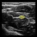 Ultrazvukové zobrazení nervus medianus